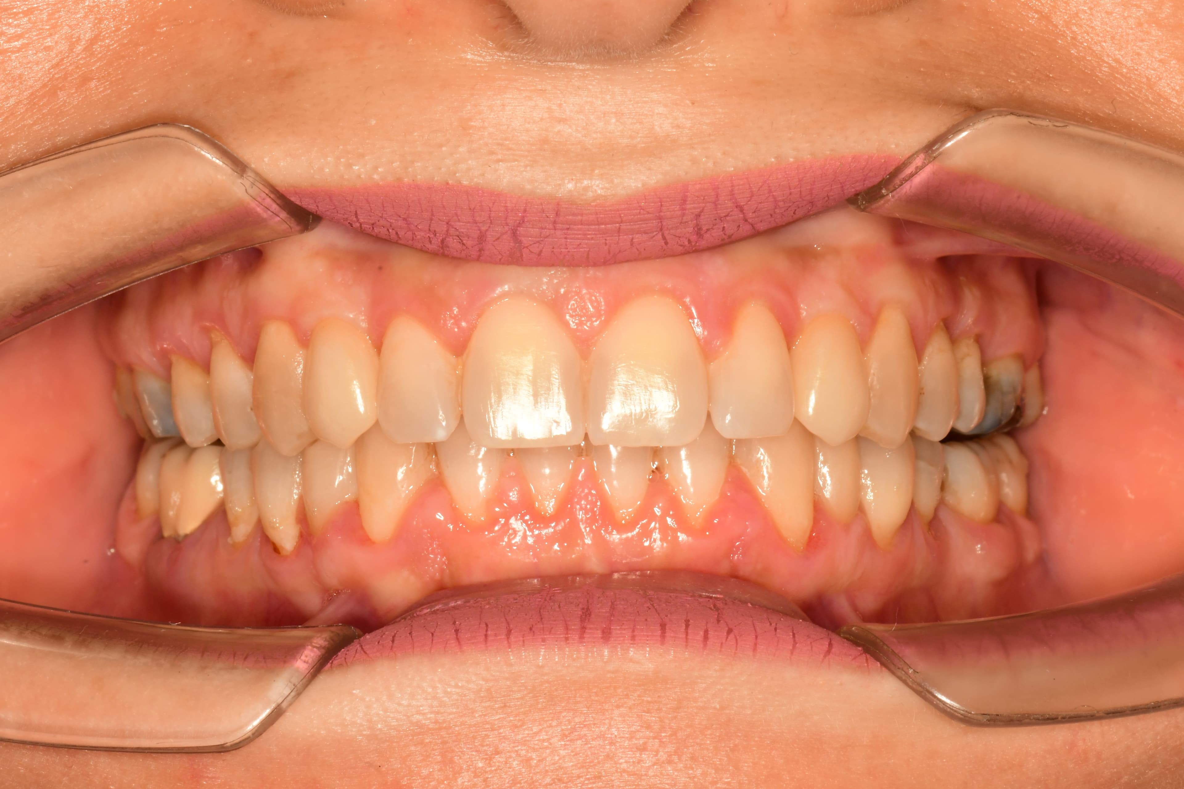 A Case That Defied Conventional Thinking, Front view, after treatment