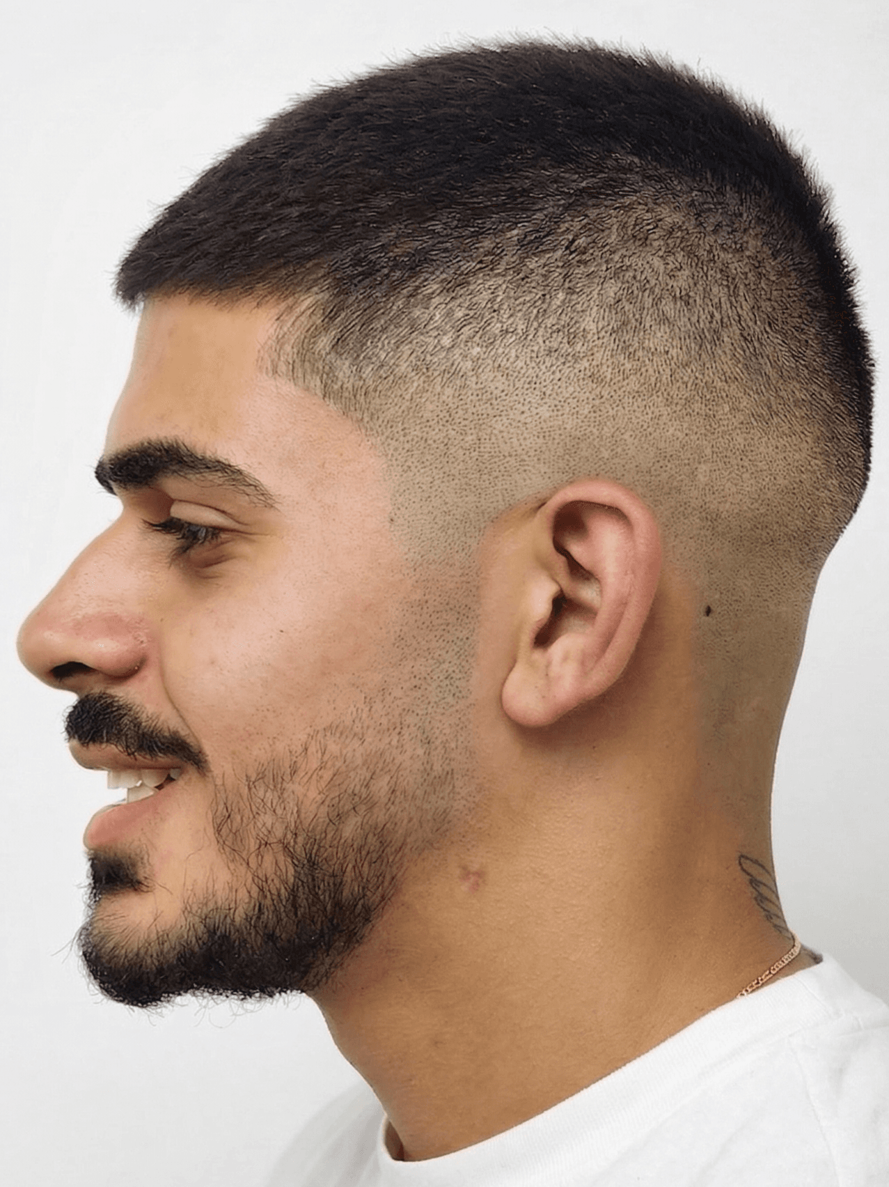 When braces alone are not enough!, Profile view, after treatment