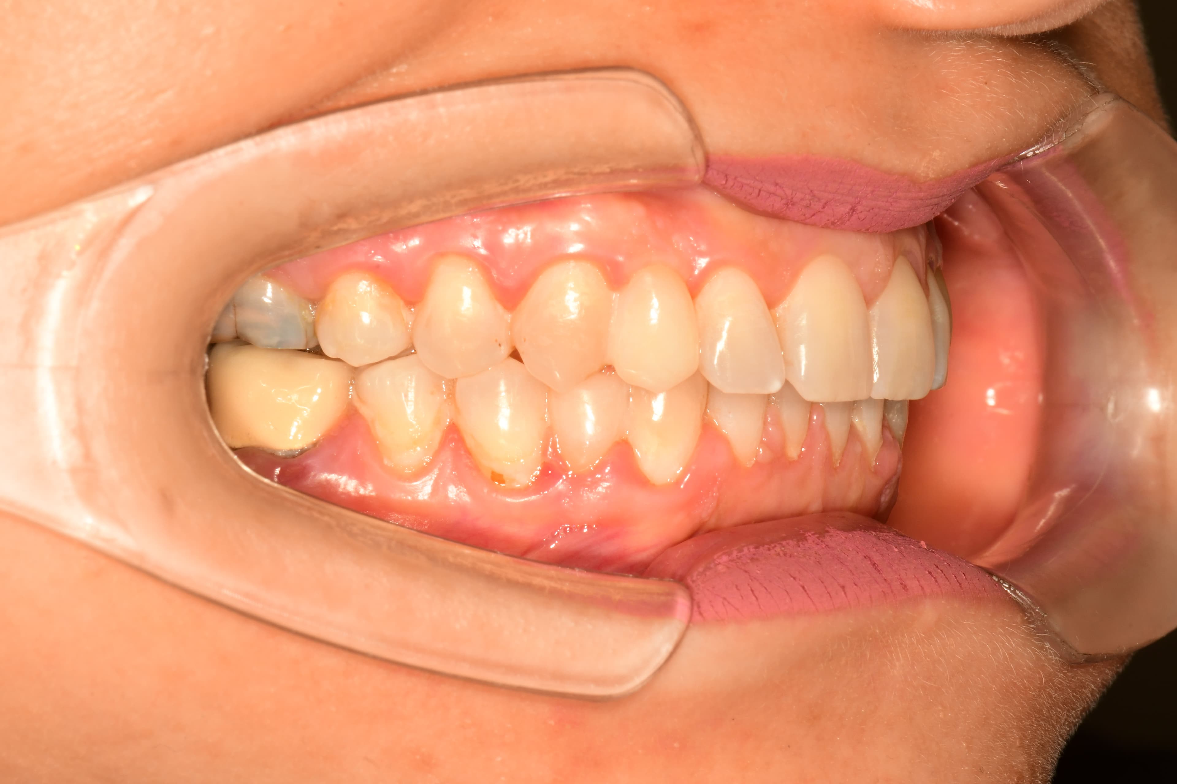 A Case That Defied Conventional Thinking, Side view, after treatment