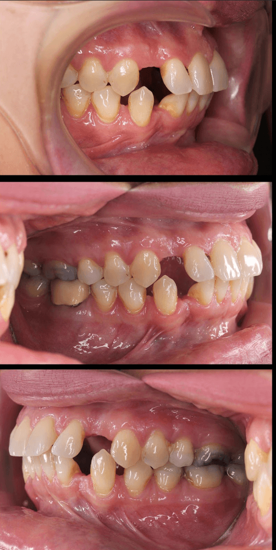 A Case That Defied Conventional Thinking, Side view, before treatment