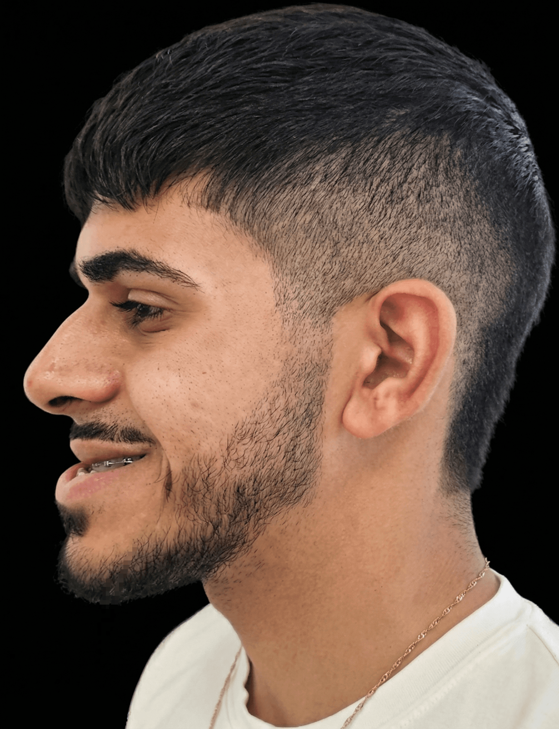 When braces alone are not enough!, Profile view, before treatment
